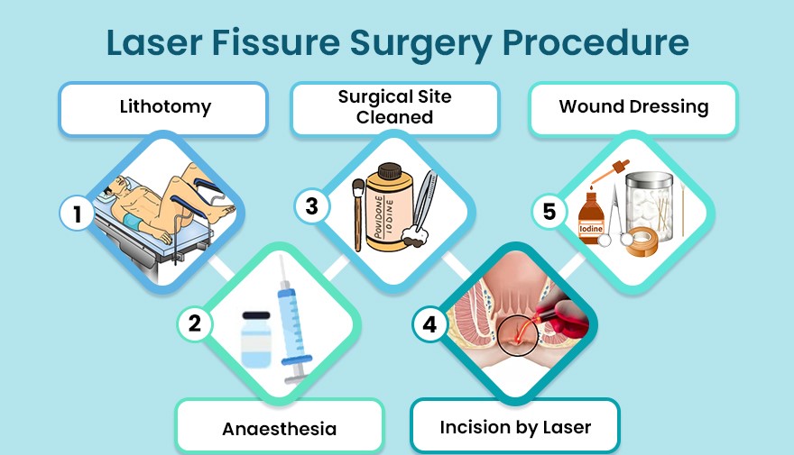 Laser Fissure Surgery Procedure